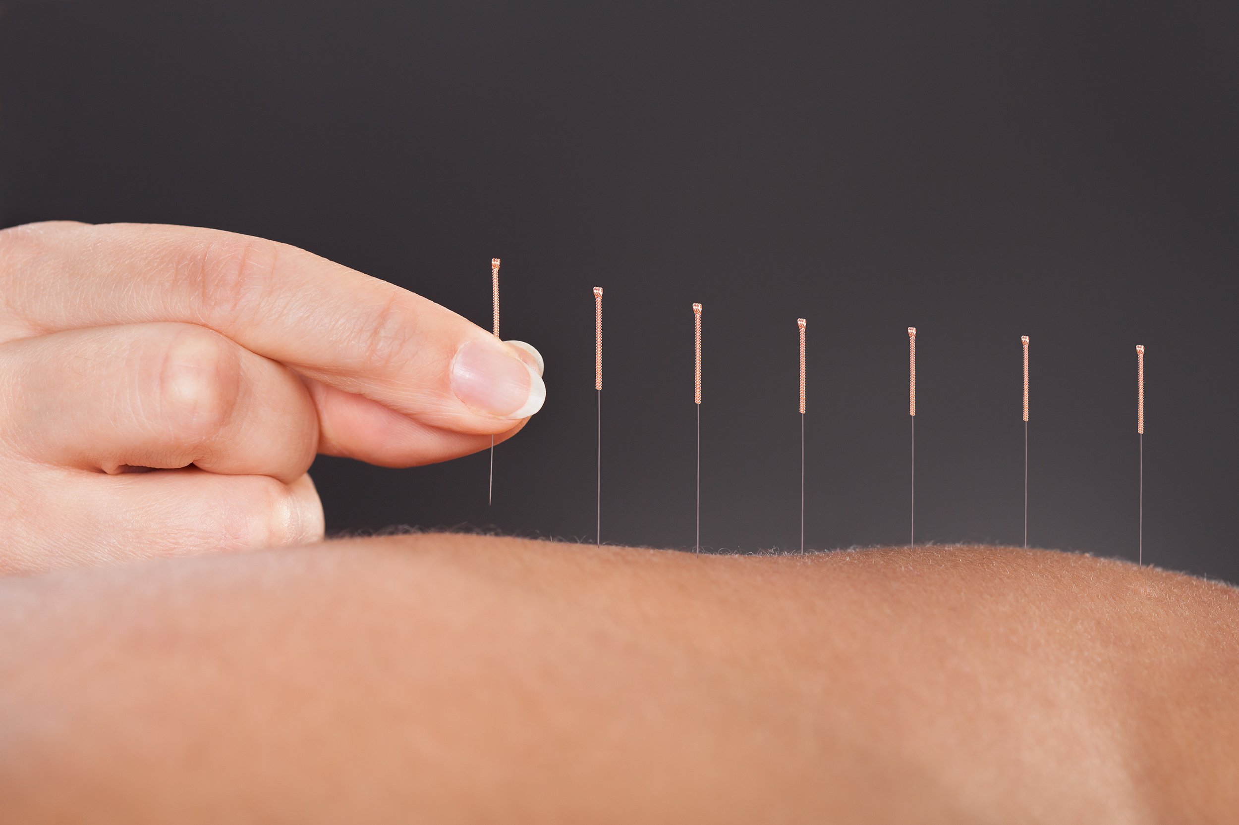 close-up of a person getting an acupuncture treatment at spa