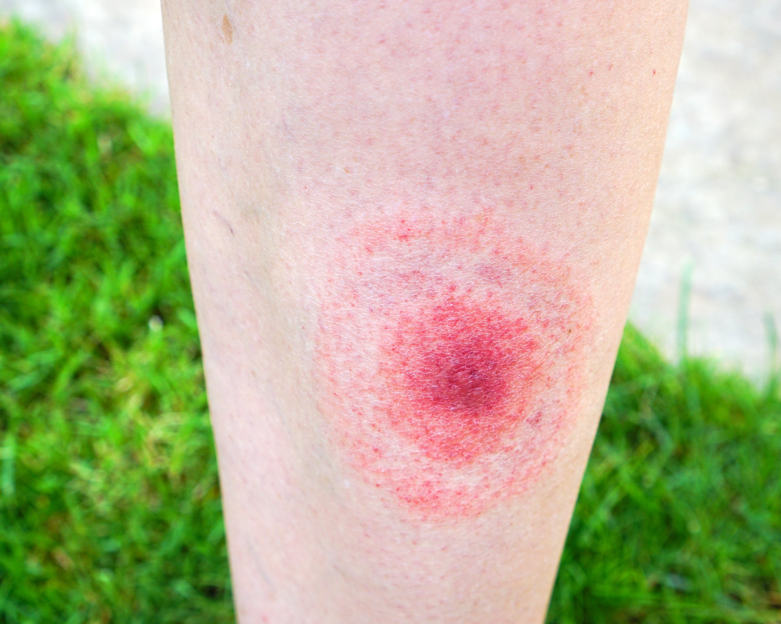 typical lyme disease rash on leg while outside