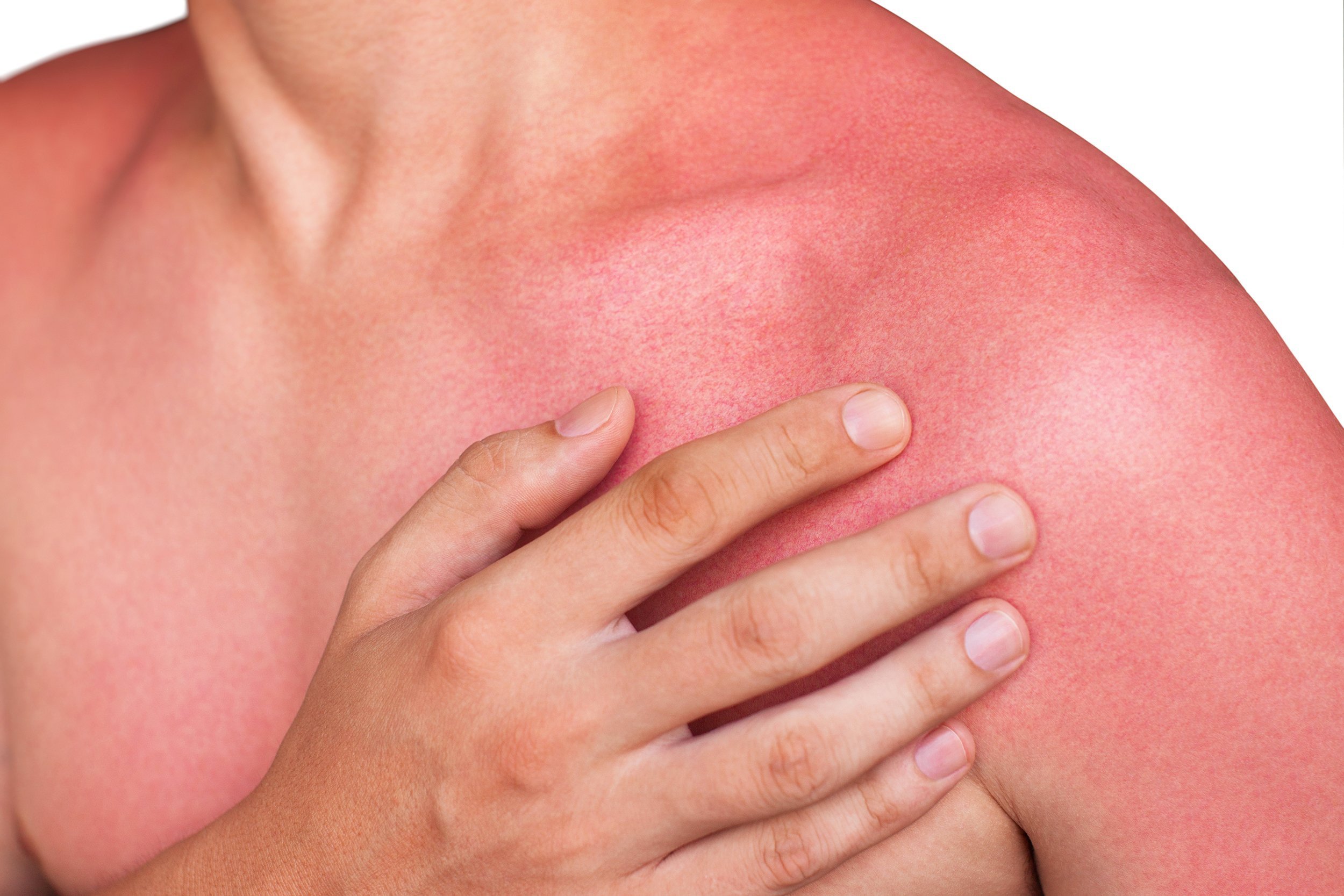 man with reddened, itchy skin after sunburn