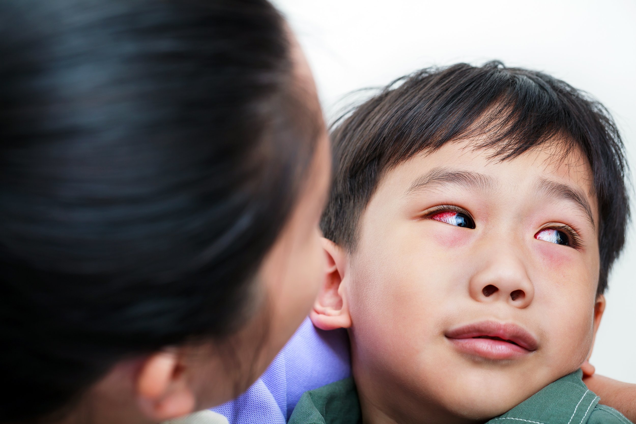 little boy with pinkeye being cared for by his mother