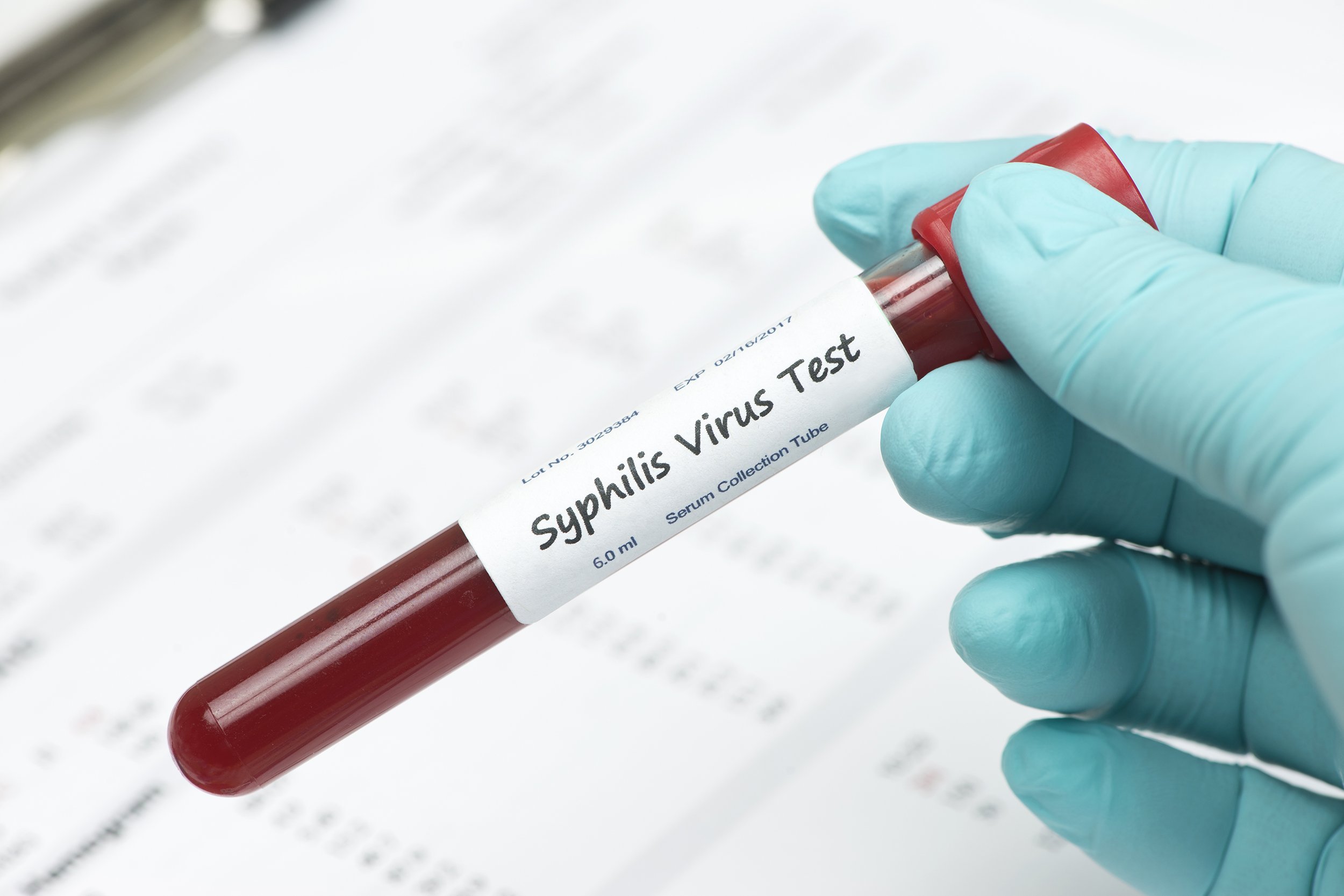 syphilis virus blood sample collection tube held by technician with lab report
