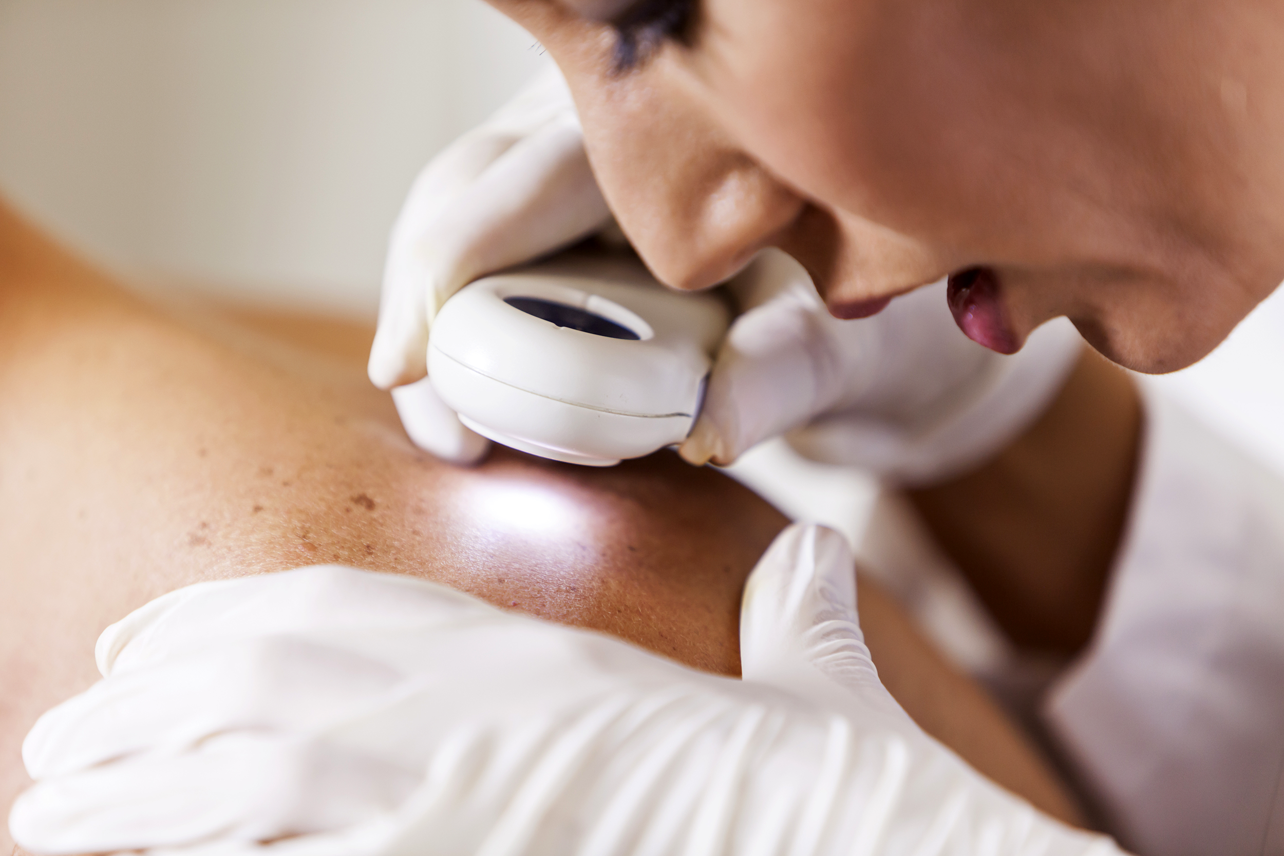 Doctor looking closely at a shoulder for a melanoma
