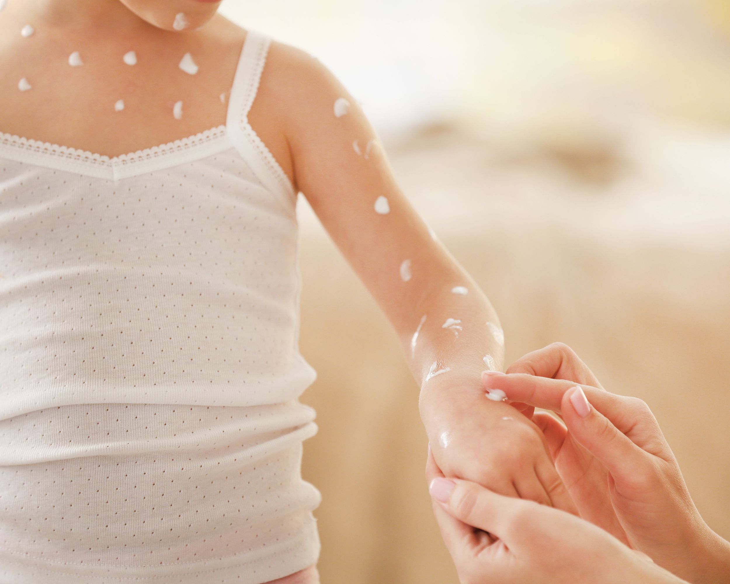 female hand applying cream on little girl with chicken pox at home
