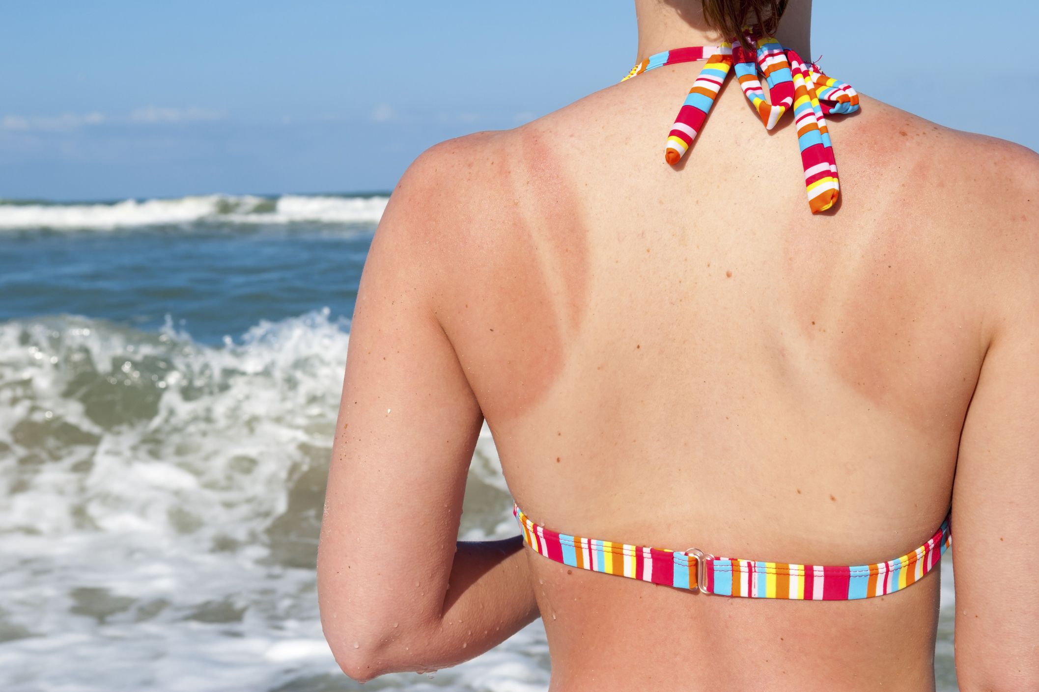 young girl with sunburned back standing in front of beach