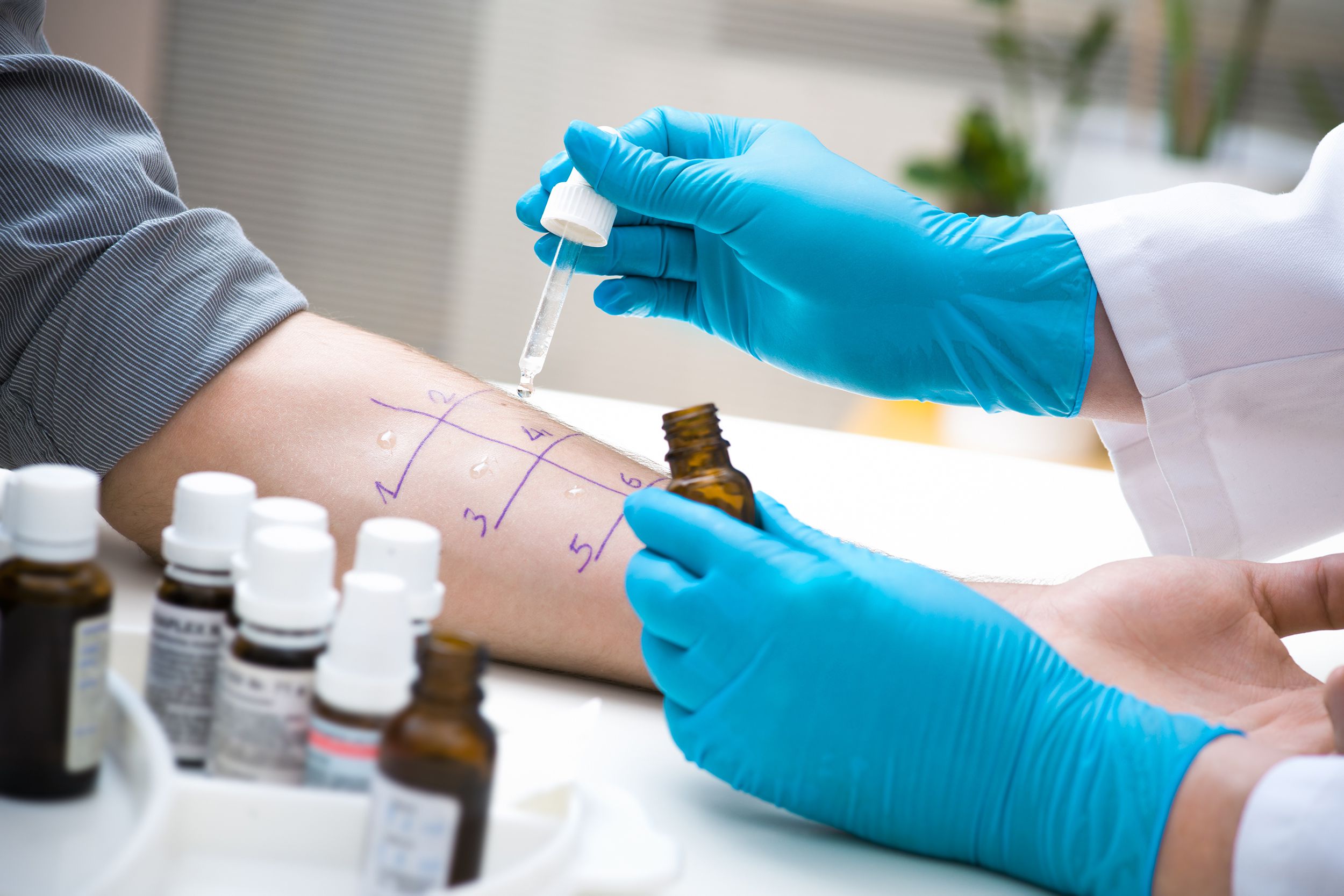 man getting skin allergy testing at dermatologist office