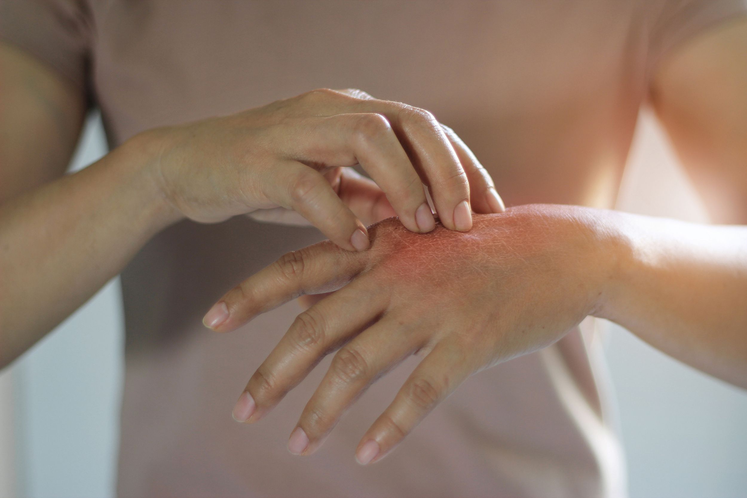 female scratching the itch on her hand, cause of itching from skin diseases, dry skin