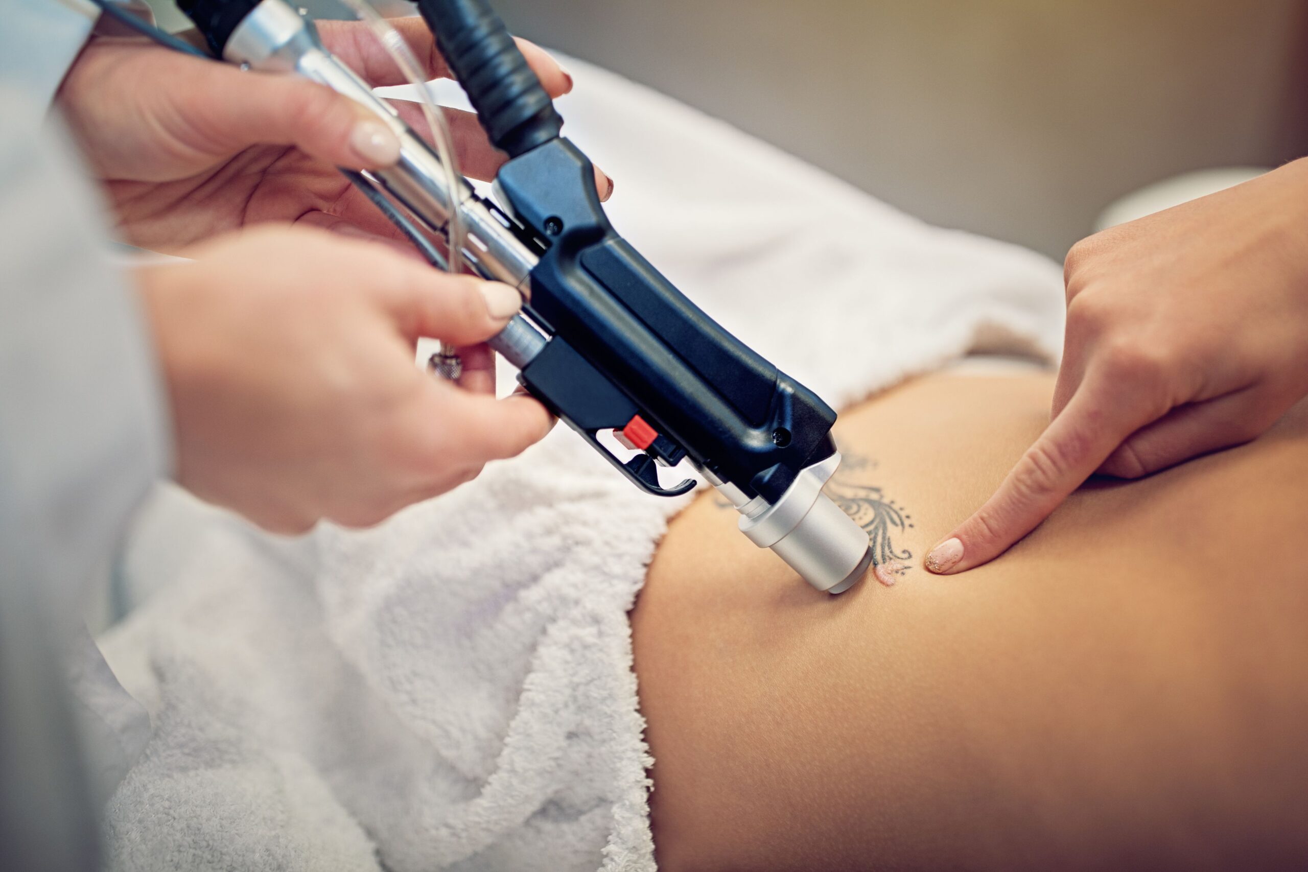 laser tattoo removal