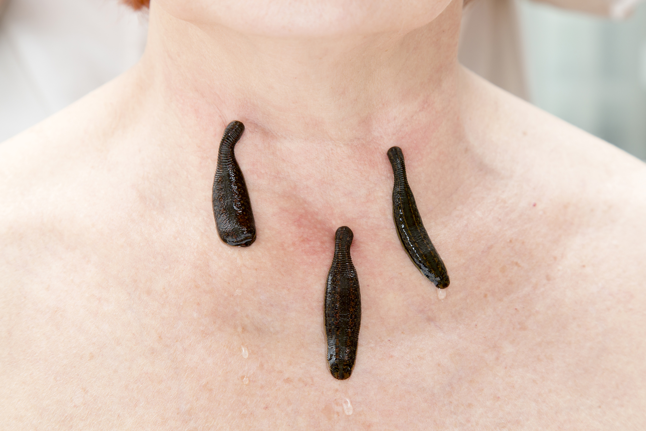 Leeches for medical use