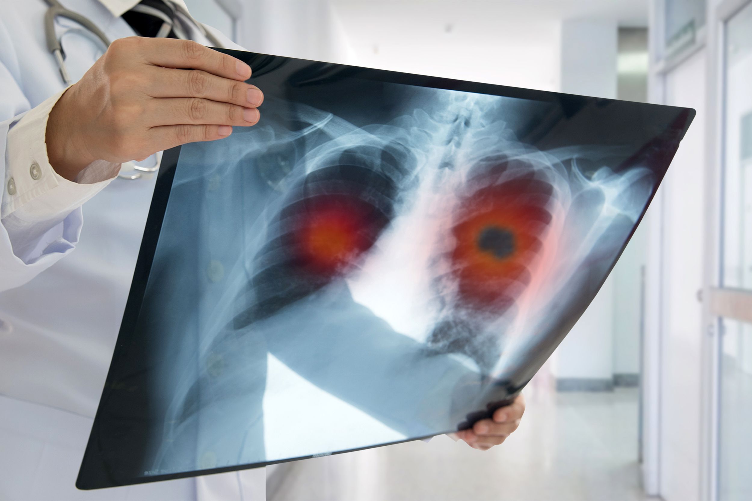 Doctor holding an X-ray of lung cancer