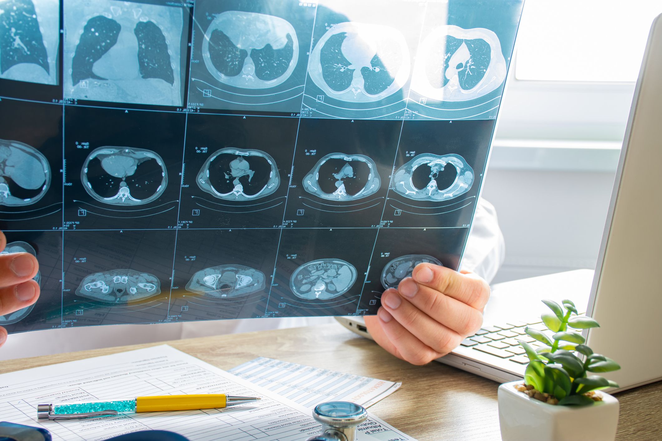 CT Scans
