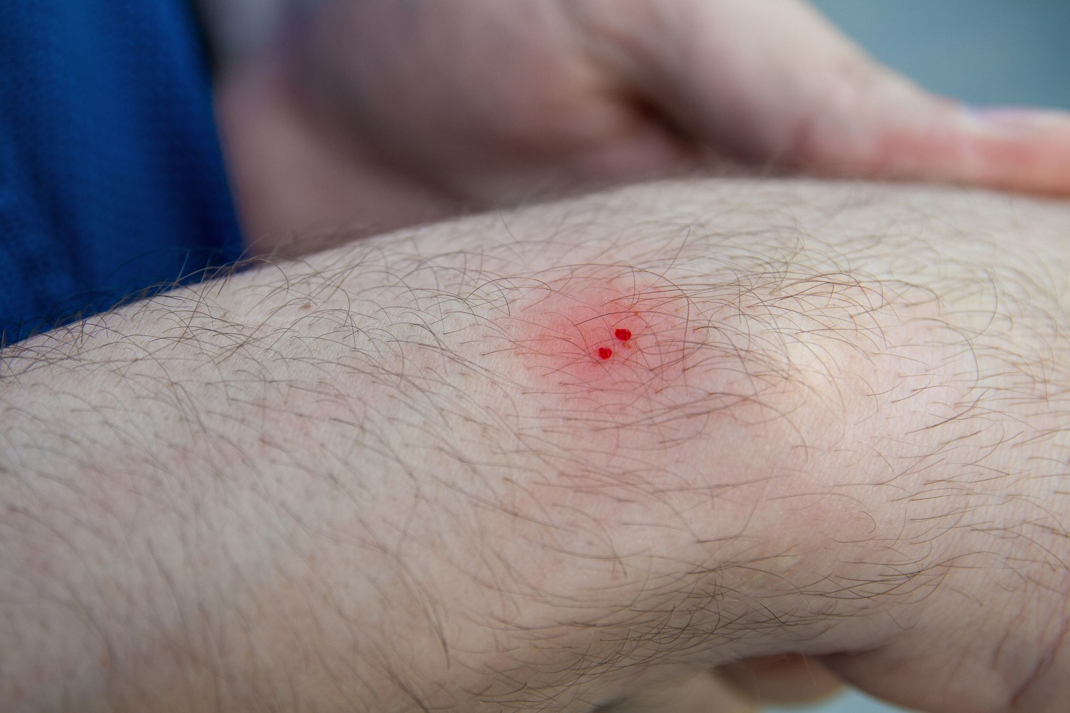 Male hand with the wound from snake bite or snakebite. Bite marks and red skin. Closeup, selective focus