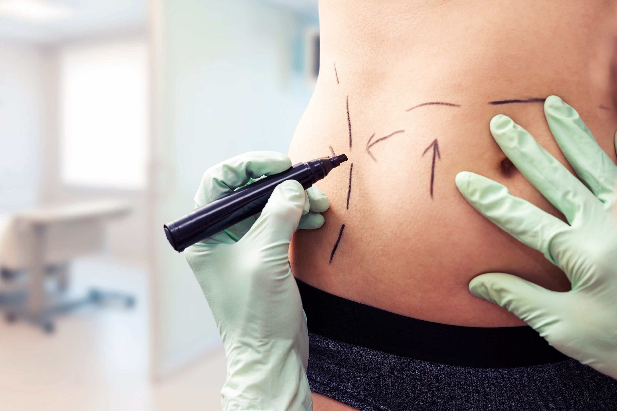 woman getting her stomach marked for plastic surgery
