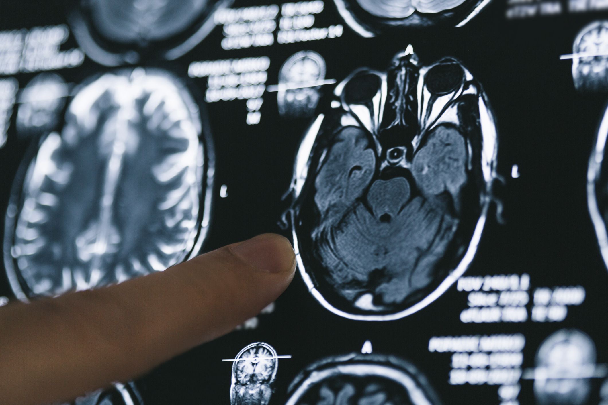 finger pointing at brain scan