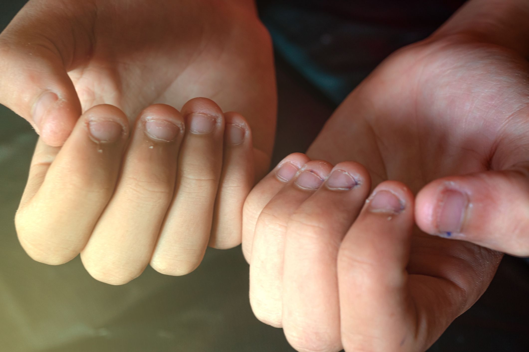 Bite the nails. A hand with some ugly nails. disgusting bitten fingernails. Fingernail that is disgusting because of the nail biting.