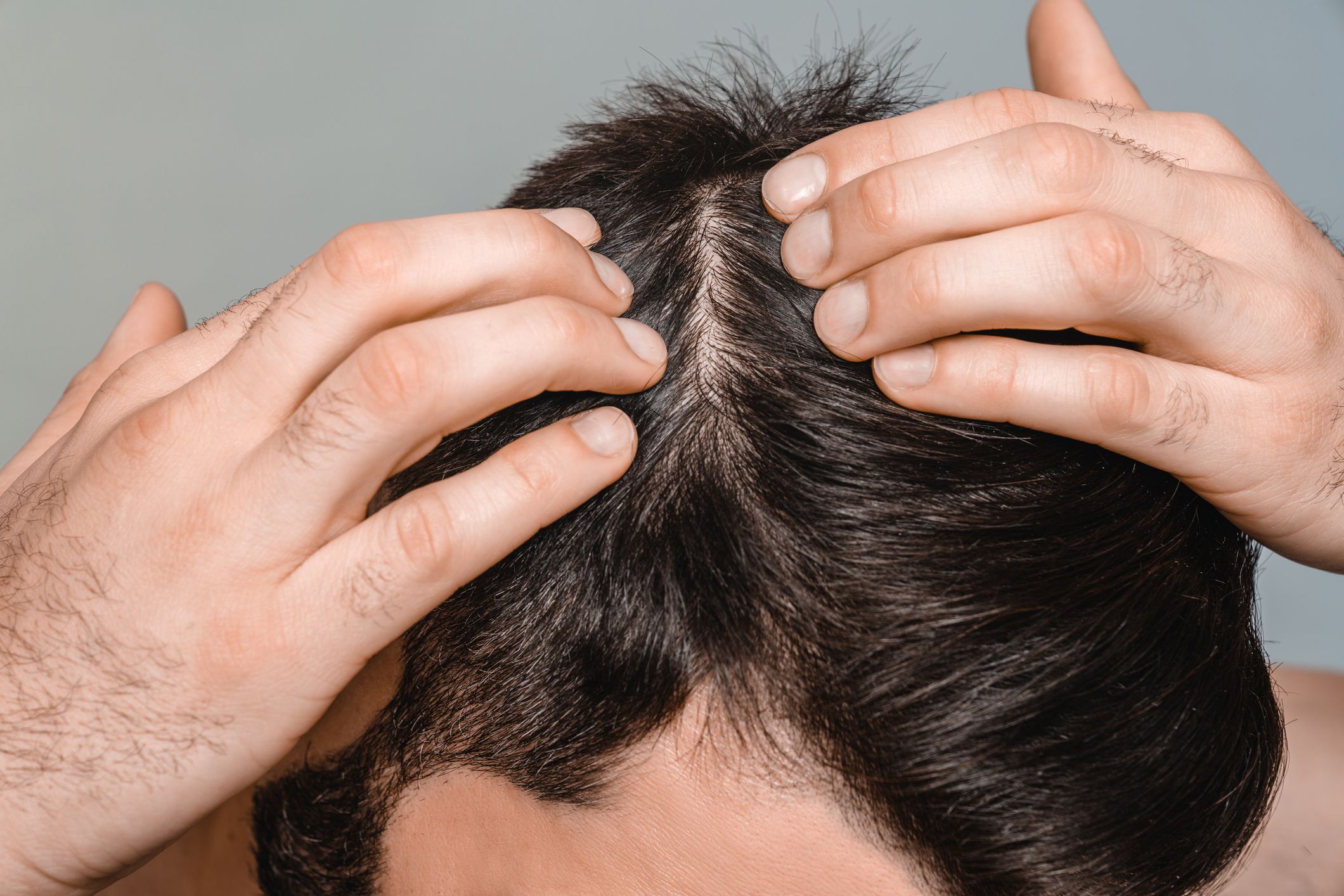 Closeup male dark hair. Head skin problems, receding hairline, alopecia, dandruff concept. Healthy treatment for seborrhea, psoriasis, dermatitis. Shampoo conditioner advertisement