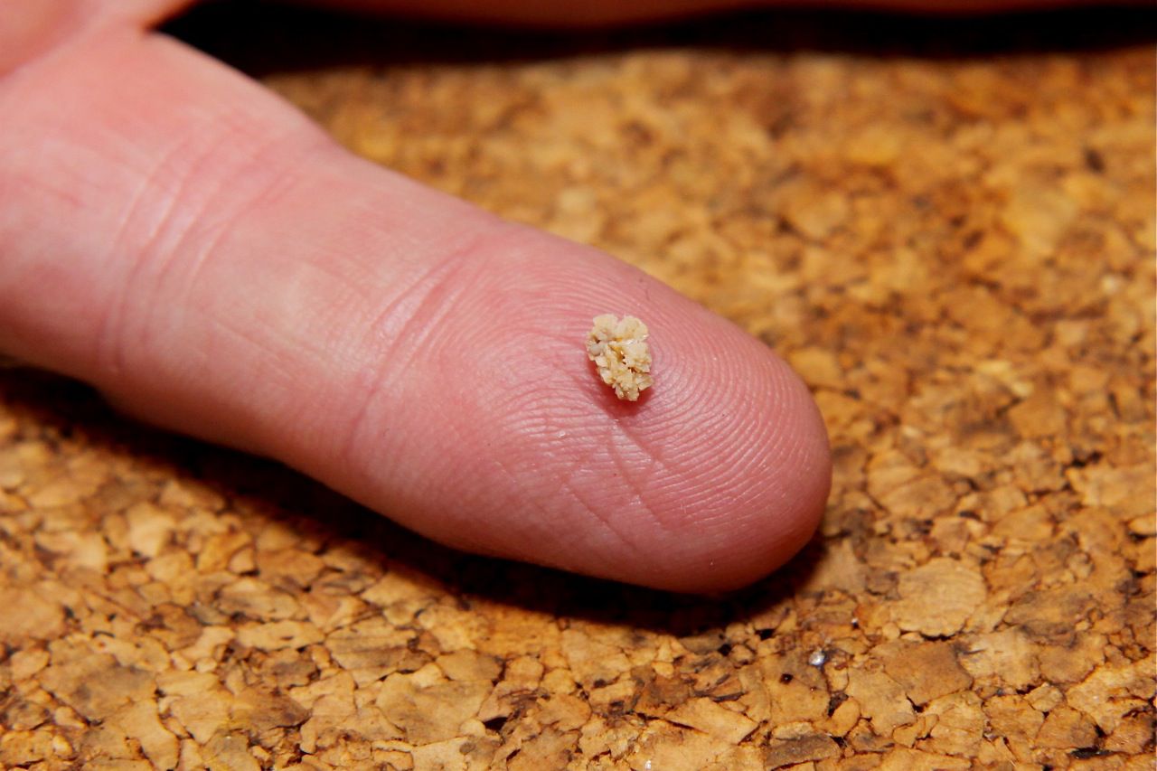 Photo of a kidney stone on a finger tip in front of a cork background.
