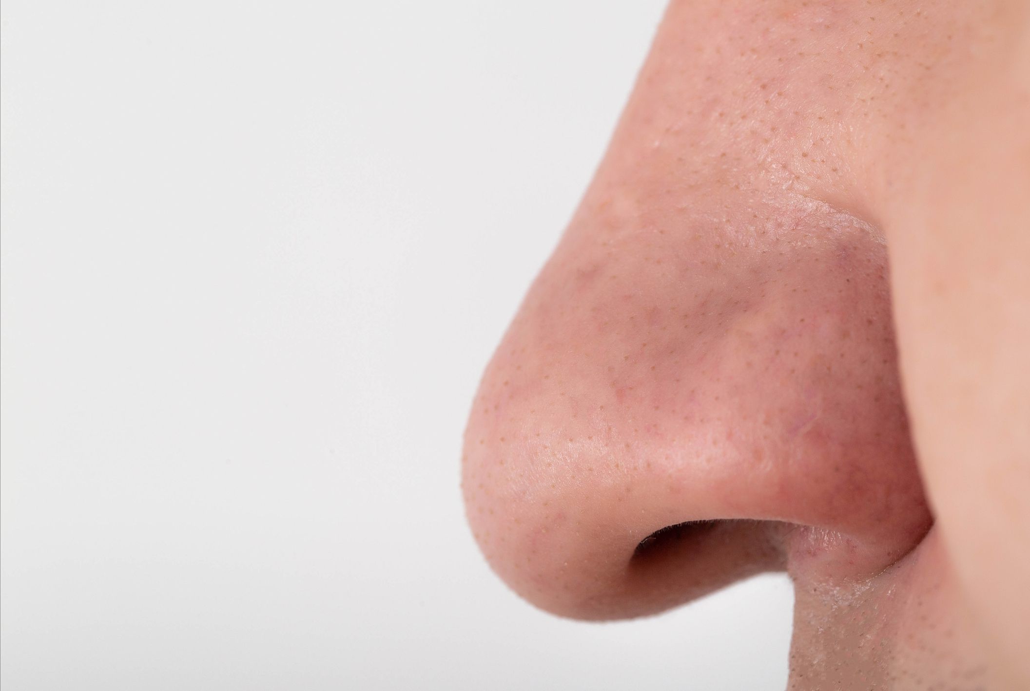 A man has a wide fleshy big nose, close-up. Nose reduction plastic surgery concept, copy space for text, otorhinolaryngolory