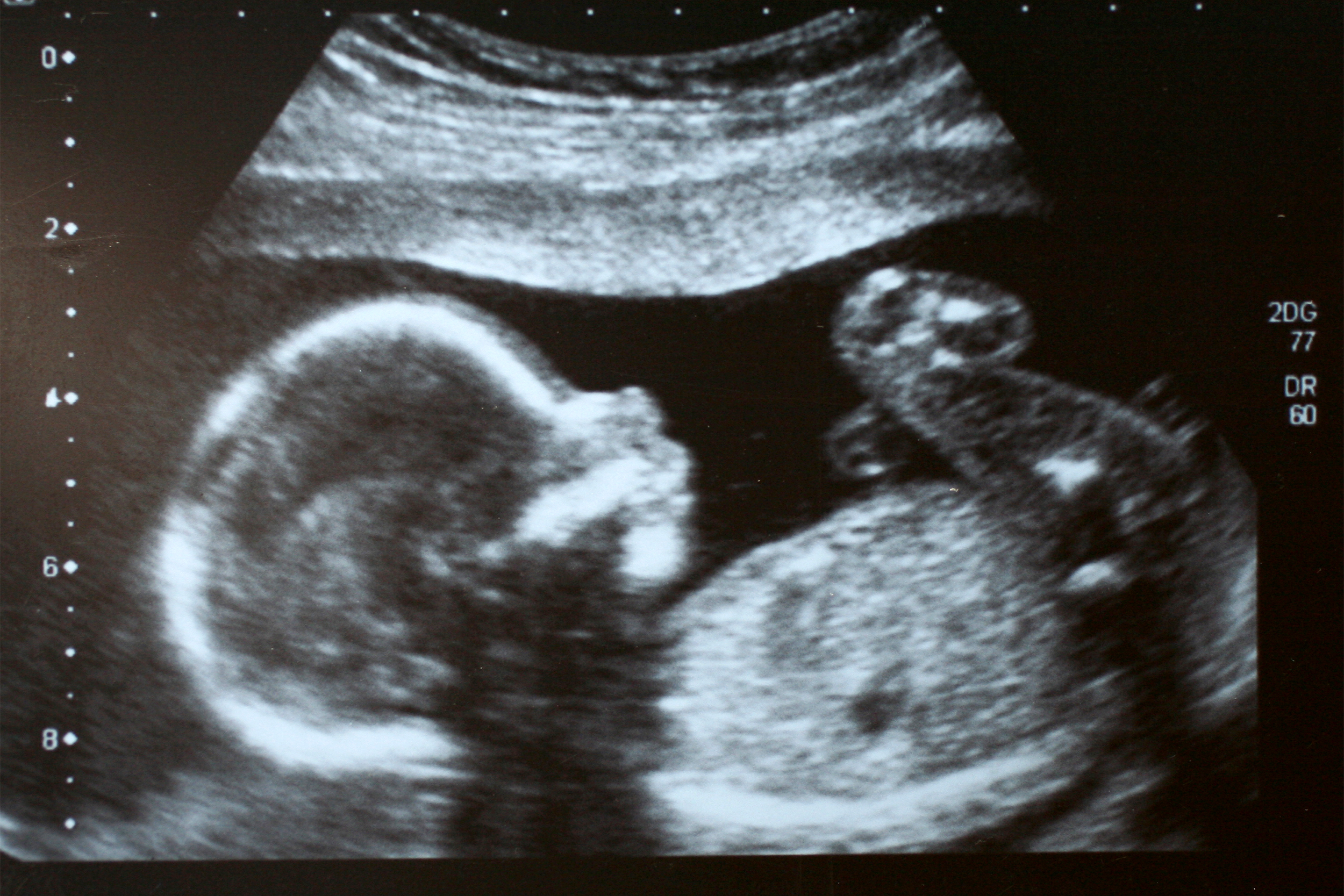ultrasound