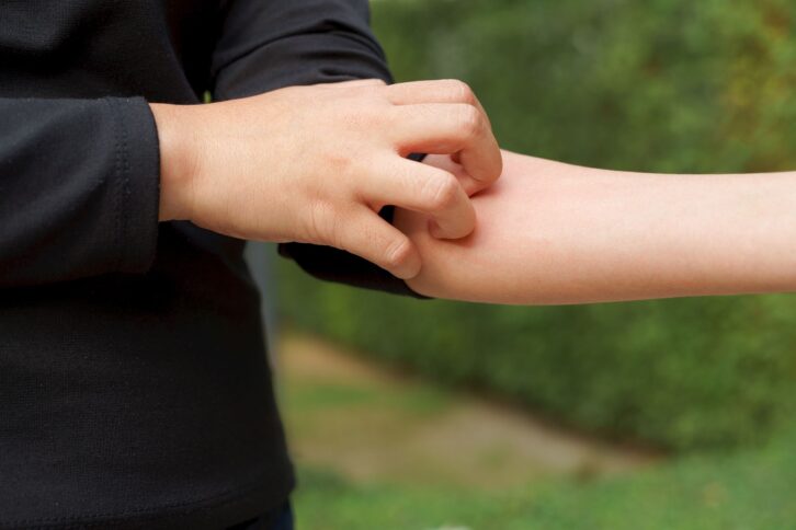 closed up of hands scratching arm with red sensitive skin